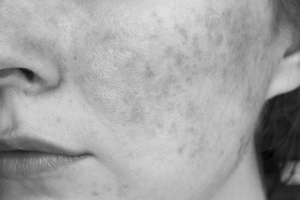 Rosacea2