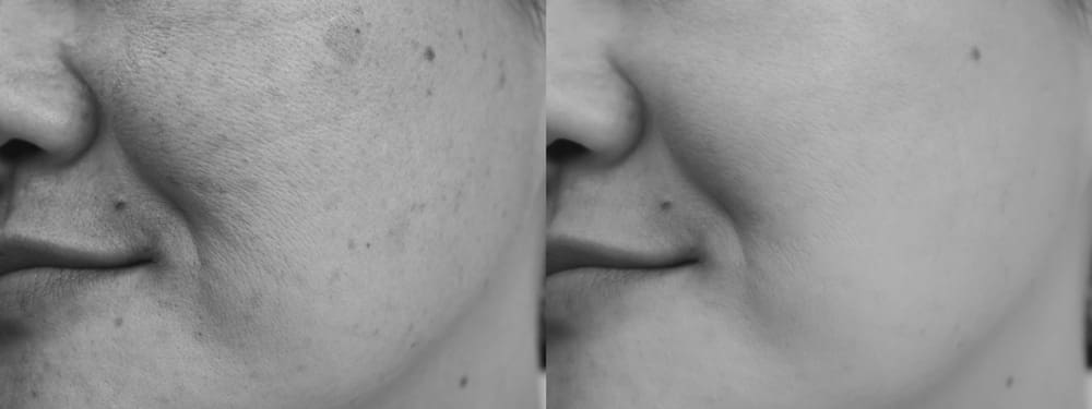 Skin1
